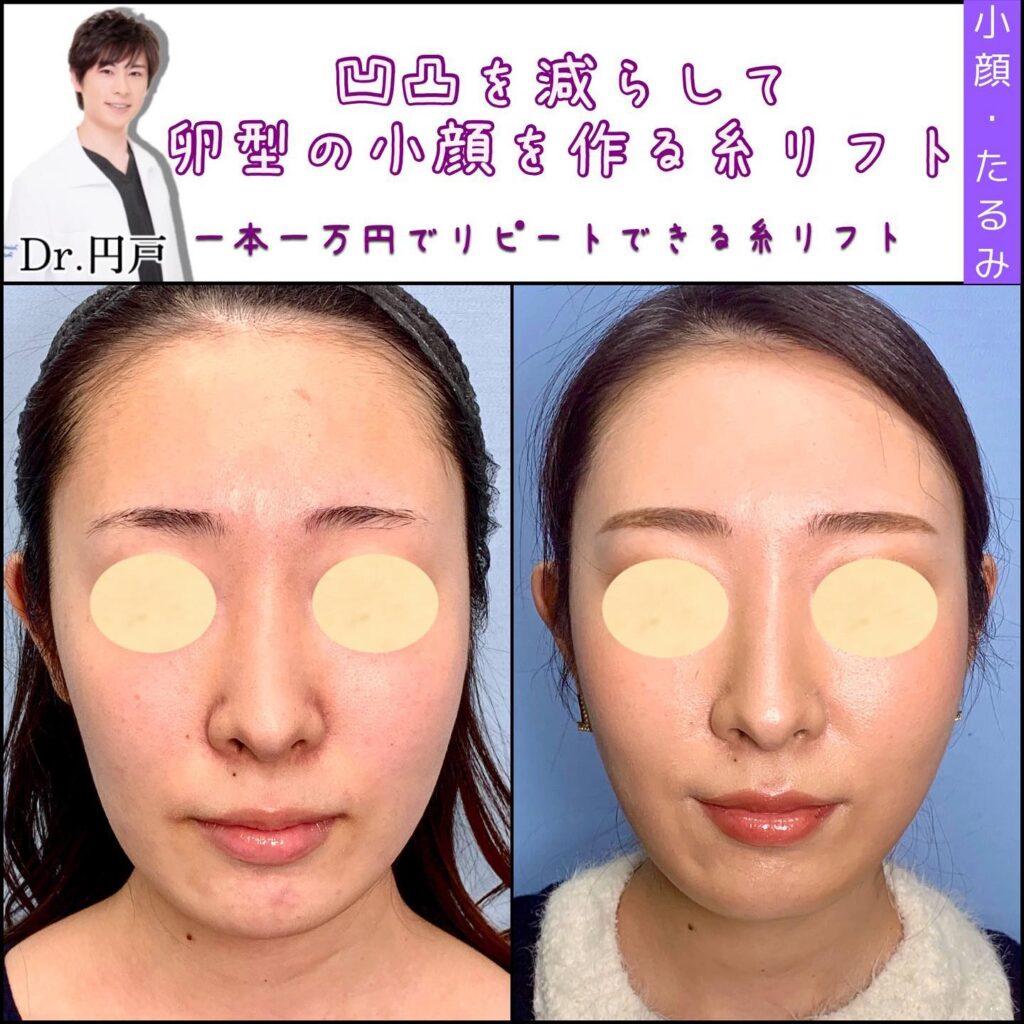 糸リフトの症例写真 (14)