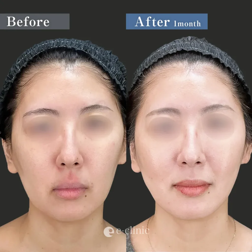 脂肪吸引（頬・顎下・ジョールファット）＋糸リフト（名医の島田良浩医師が執刀）（13）