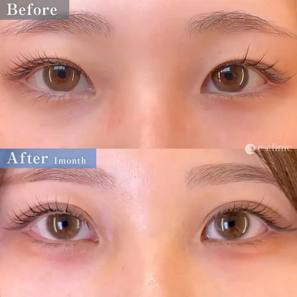 二重埋没_フォーエバークロス特殊5点留め（7）