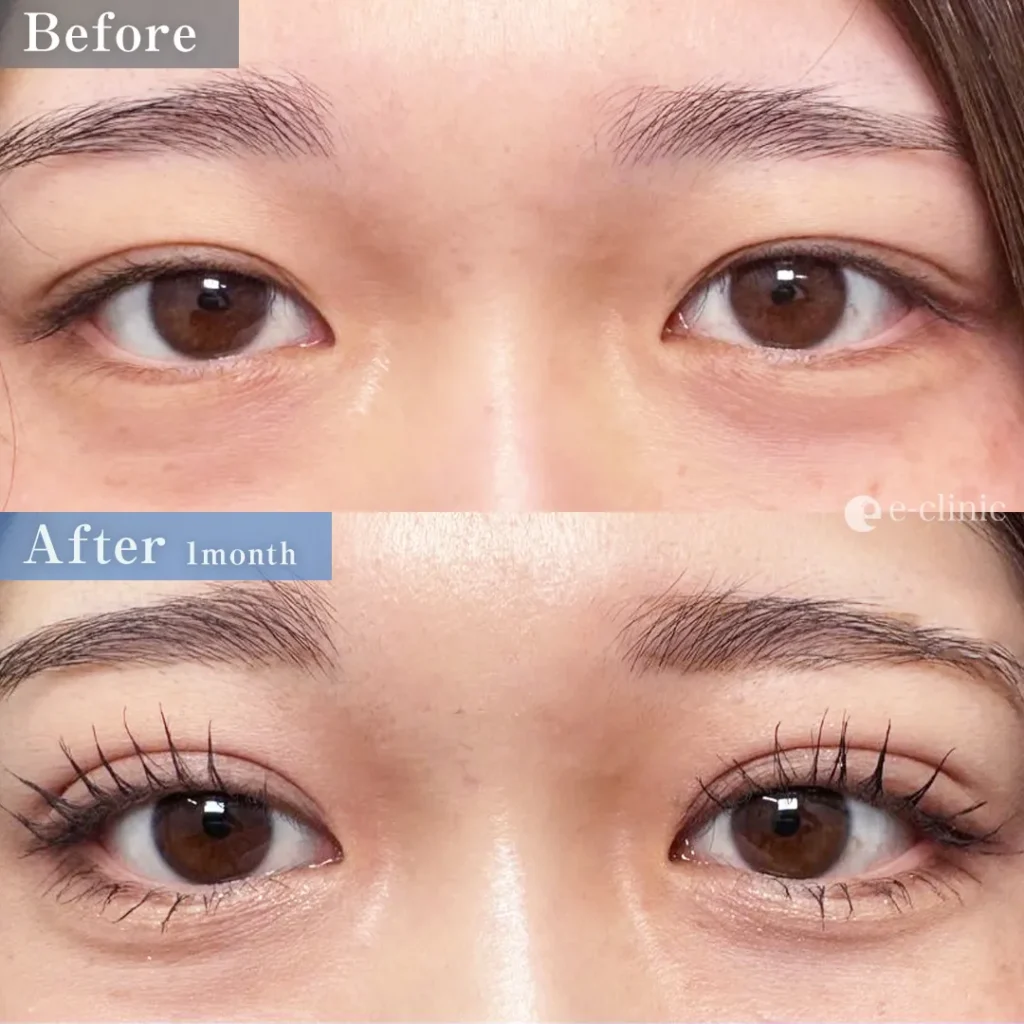 二重埋没法_自然癒着法（名医の八木良太医師が執刀）（79）