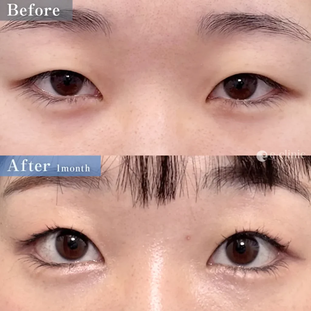 タレ目形成（結膜法）＋目尻切開（名医の八木良太医師が執刀）（80）