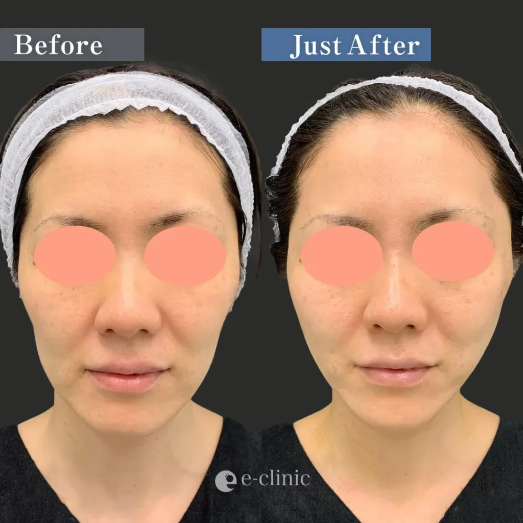 ハイブリッドフェイスリフト（名医の張田修平医師が執刀）（26）