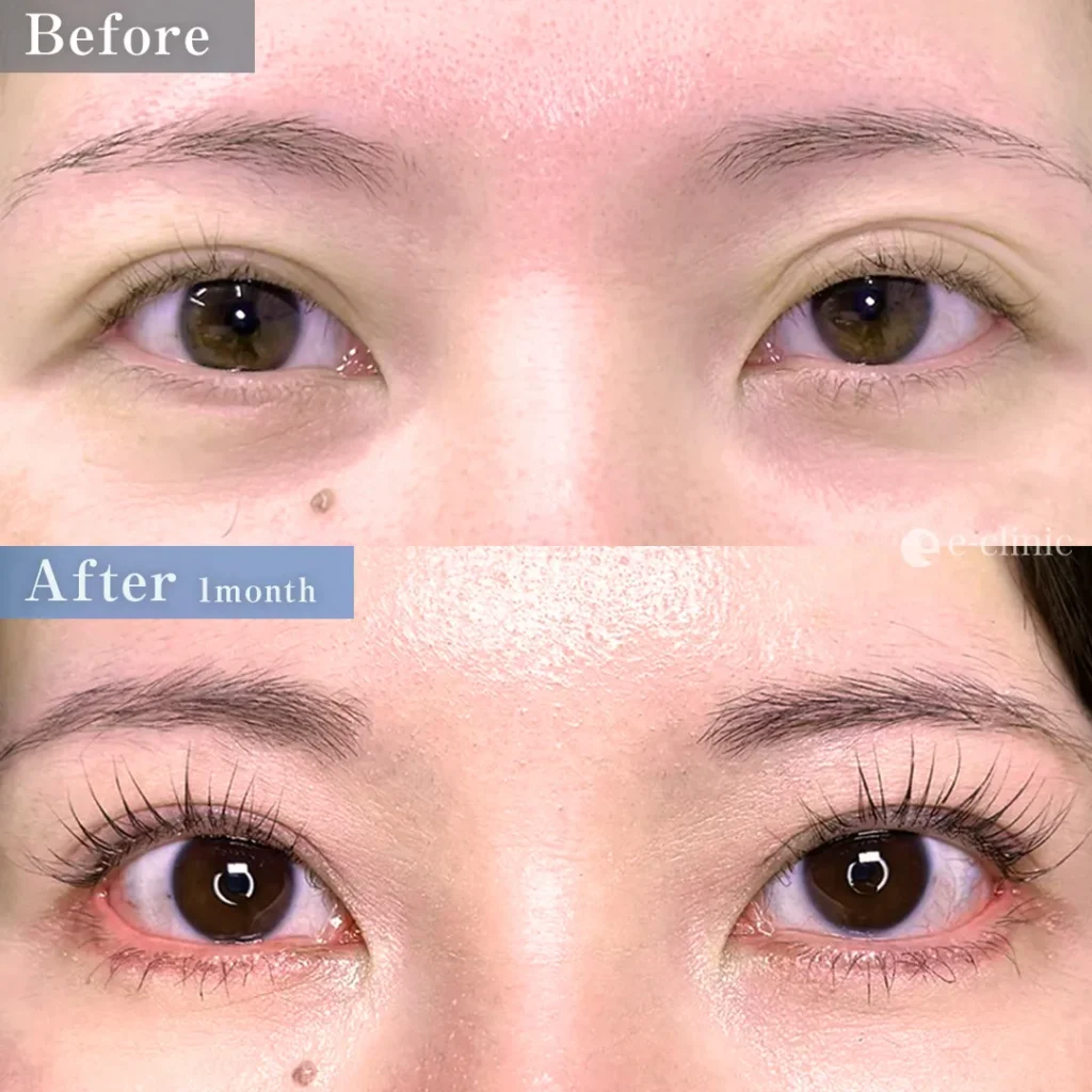 目尻切開＋タレ目形成（皮膚＋結膜）（名医の坂本優衣医師が執刀）（28）