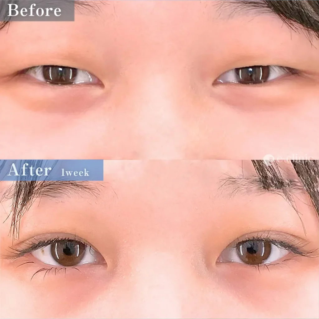 二重整形_埋没法（特殊6点裏留め）（名医の坂本優衣医師が執刀）（30）