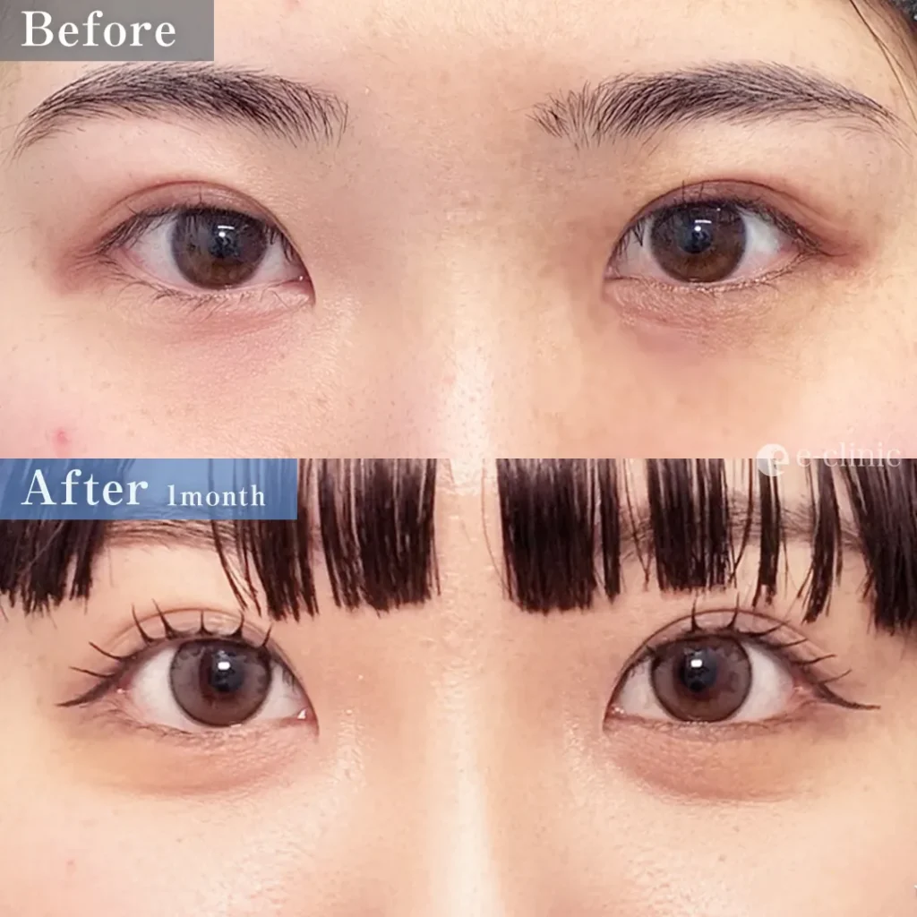 タレ目形成（結膜法）＋目尻切開＋クマ取り_経結膜脱脂（名医の八木良太医師が執刀）（78）