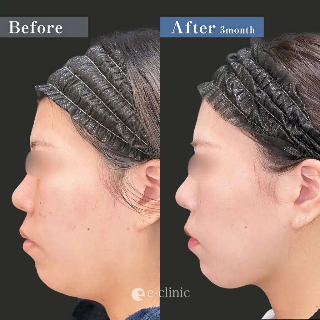 脂肪吸引（頬・顎下）＋糸リフト（名医の島田良浩医師が執刀）（11）