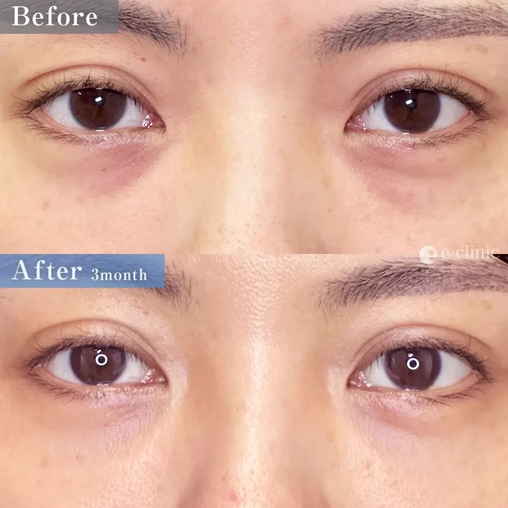 クマ取り_裏ハムラ法（名医の坂本優衣医師が執刀）（33）