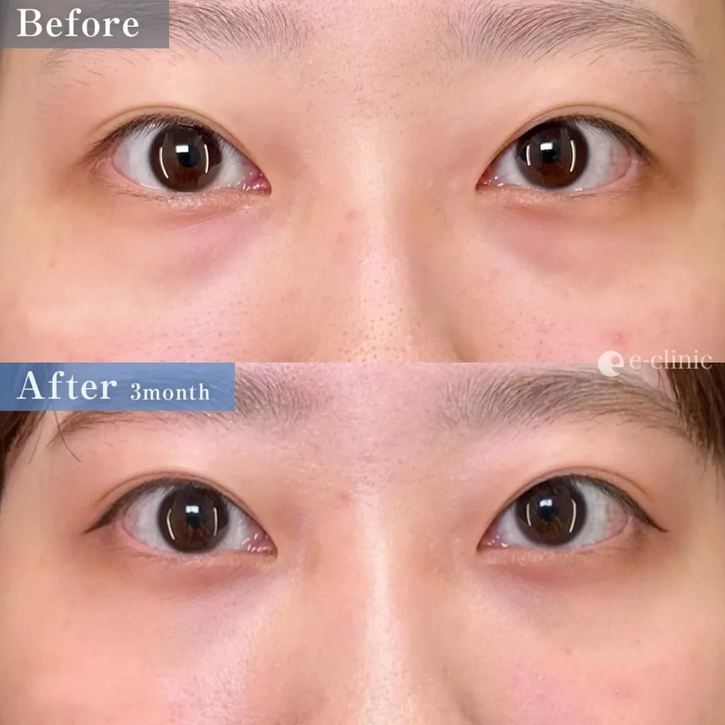 クマ取り_裏ハムラ（島田良浩）（1）