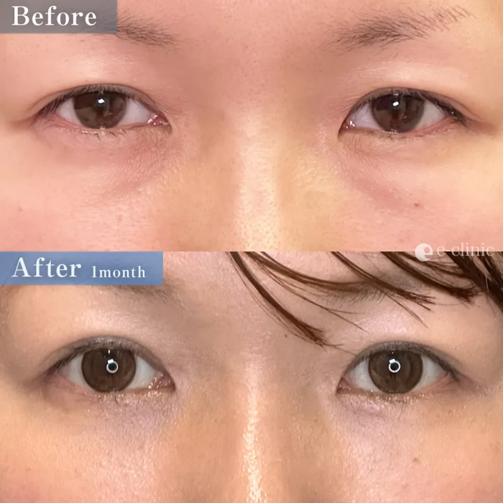 クマ取り_裏ハムラ法（名医の坂本優衣医師が執刀）（31）