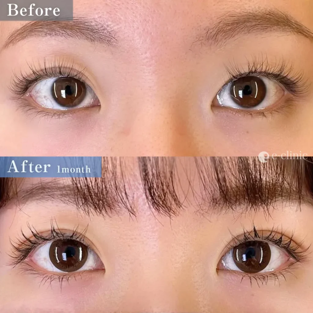 二重埋没_クイックループダブル4点裏留め（名医の島田良浩医師が執刀）（9）