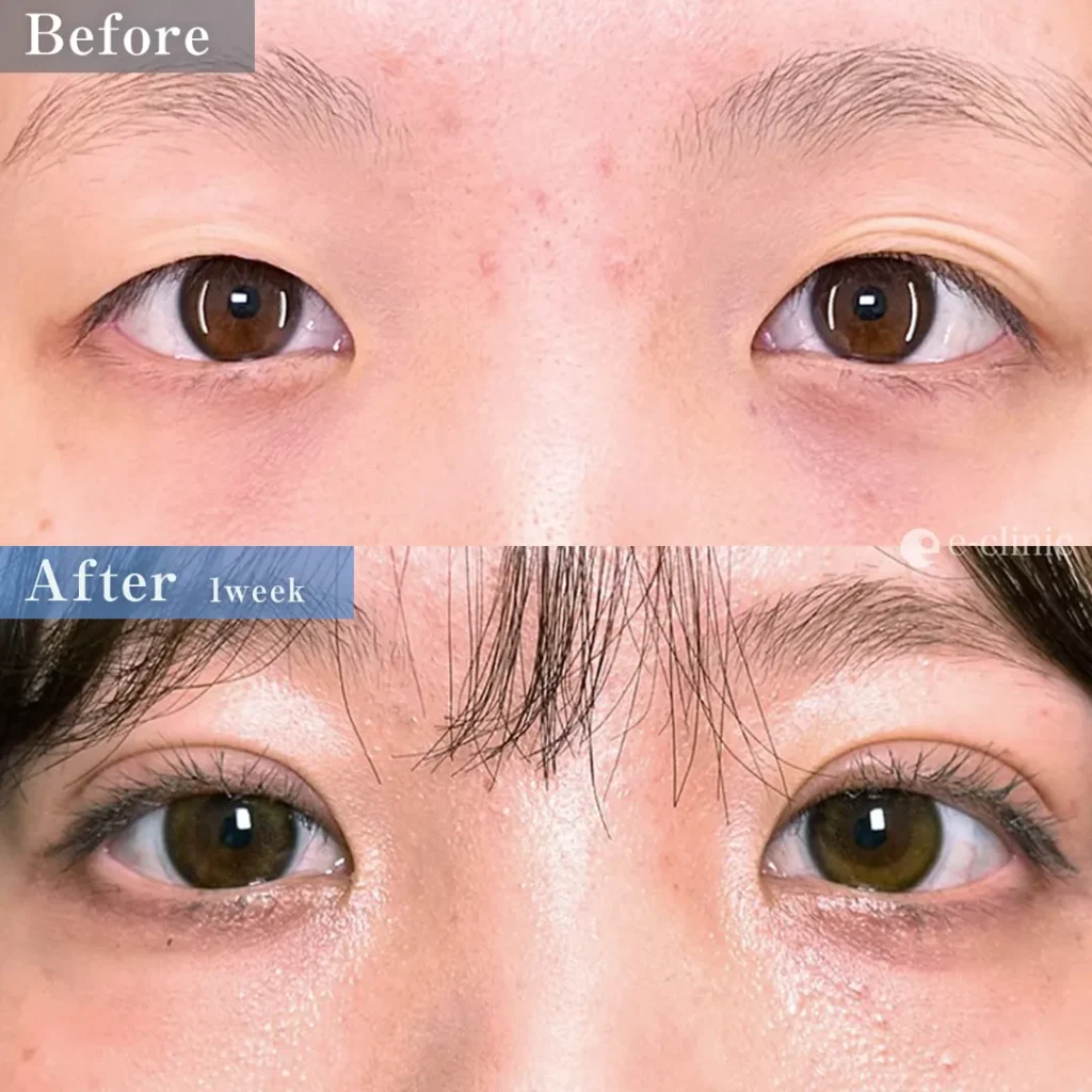 二重埋没法_自然癒着法（名医の相原隆充医師が執刀）（74）