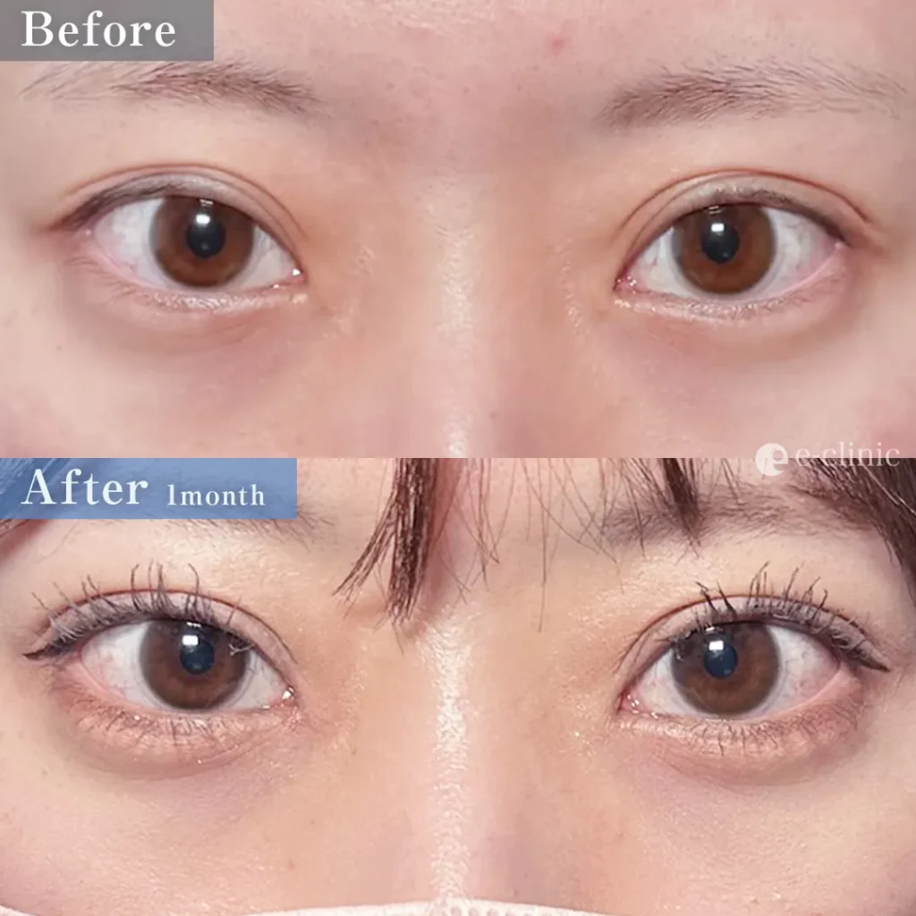 二重整形_埋没法 自然癒着法（他院修正：埋没裏留め抜糸）　（名医の伊藤渉医師が執刀）（67）