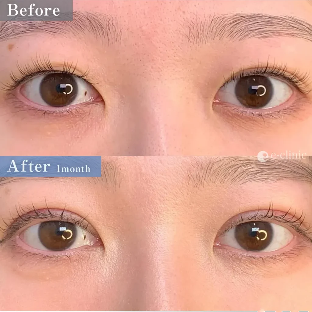 たるみ取り併用全切開二重術＋目の上脱脂（名医の張田修平医師が執刀）（21）