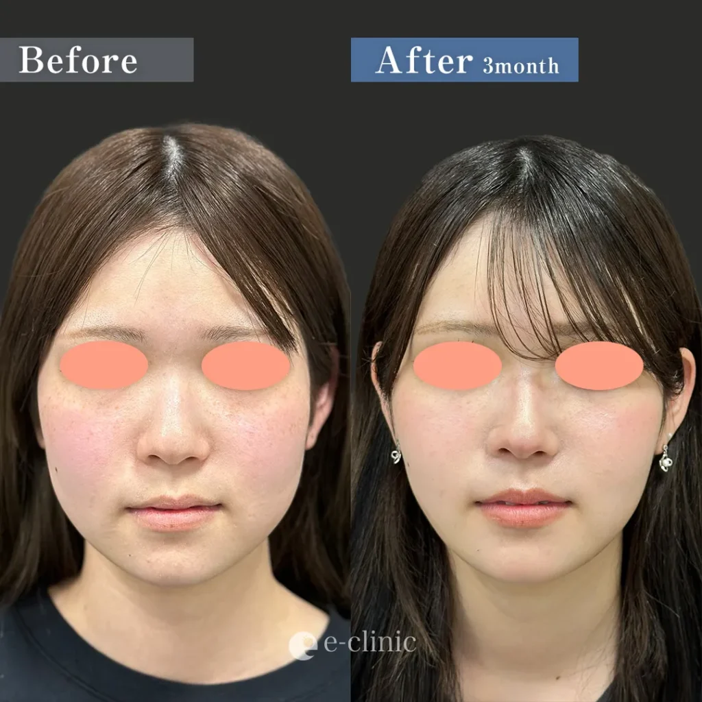 頬脂肪吸引＋糸リフト＋エラボトックス（名医の服部健人医師が執刀）（60）