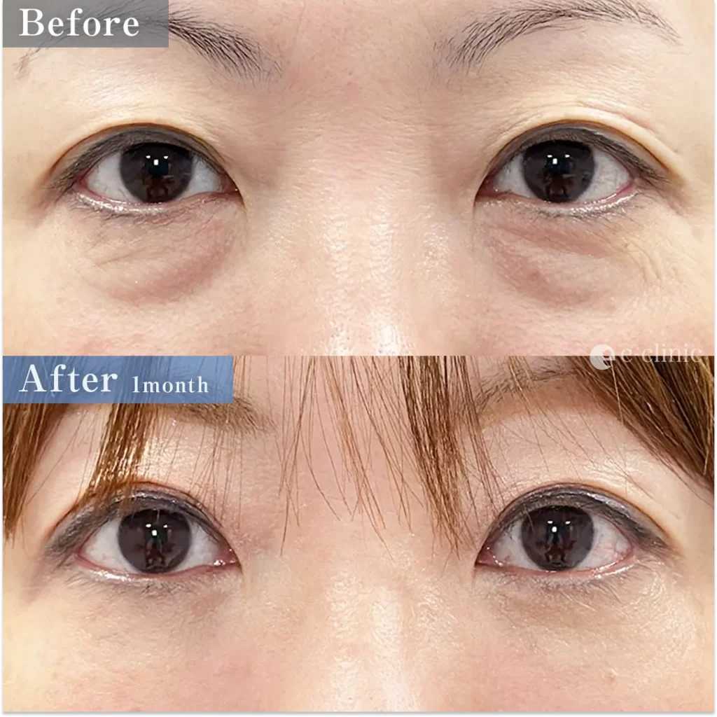 クマ取り_裏ハムラ（内固定）＋目の下脂肪注入（ナノリッチ）（服部健人）（57）