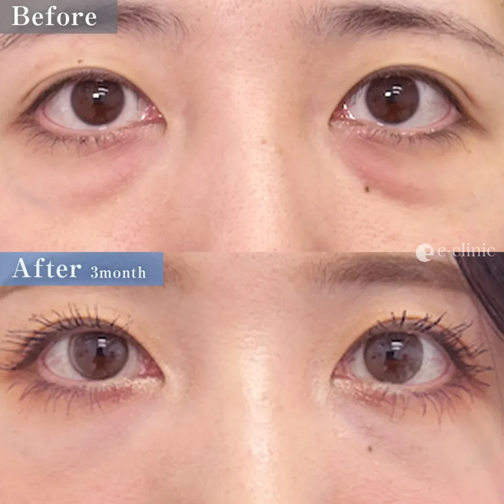 クマ取り_裏ハムラ＋目の下脂肪注入（ナノリッチ）（伊藤渉）（64）