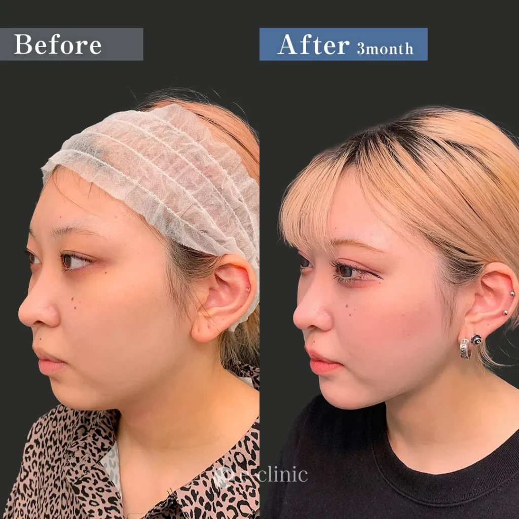 Ultra-Z脂肪吸引（頬・顎下・ジョールファット・メーラーファット）＋糸リフト（スレッドリフトプレミアム8本＋テスリフト8本）＋顎ヒアルロン酸（名医の張田修平医師が執刀）（25）