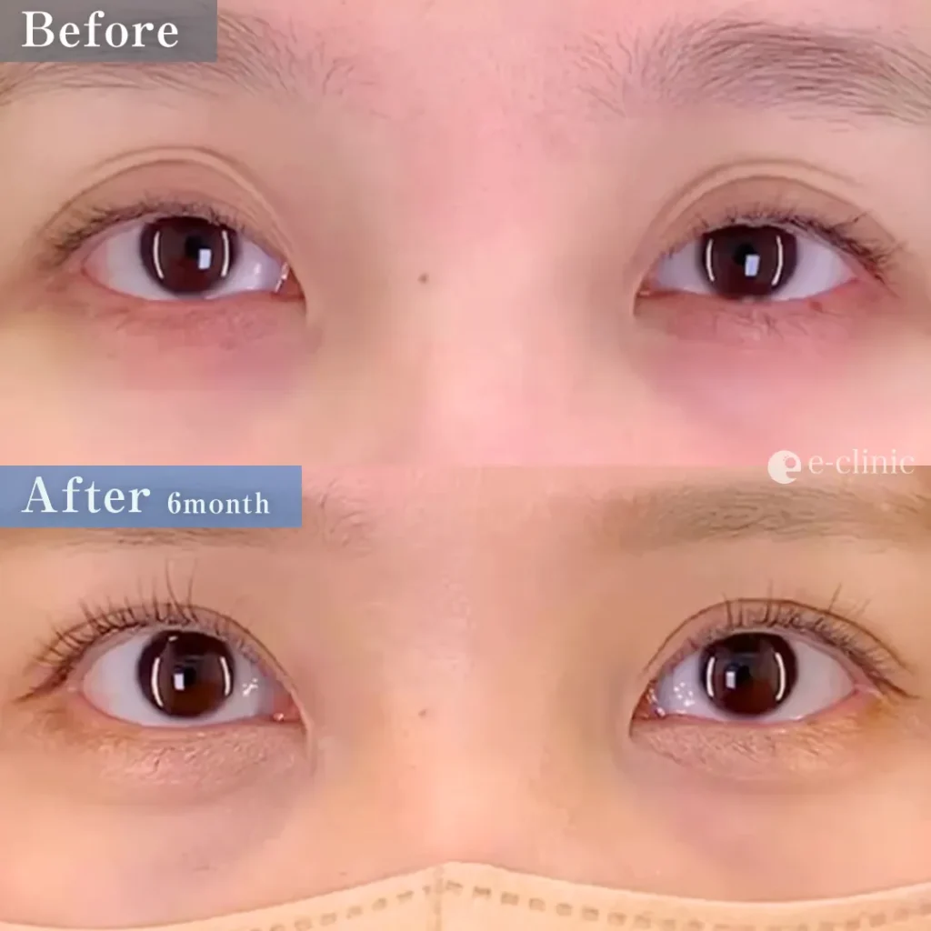 たるみ取り併用全切開二重術＋眼瞼下垂（名医の張田修平医師が執刀）（16）