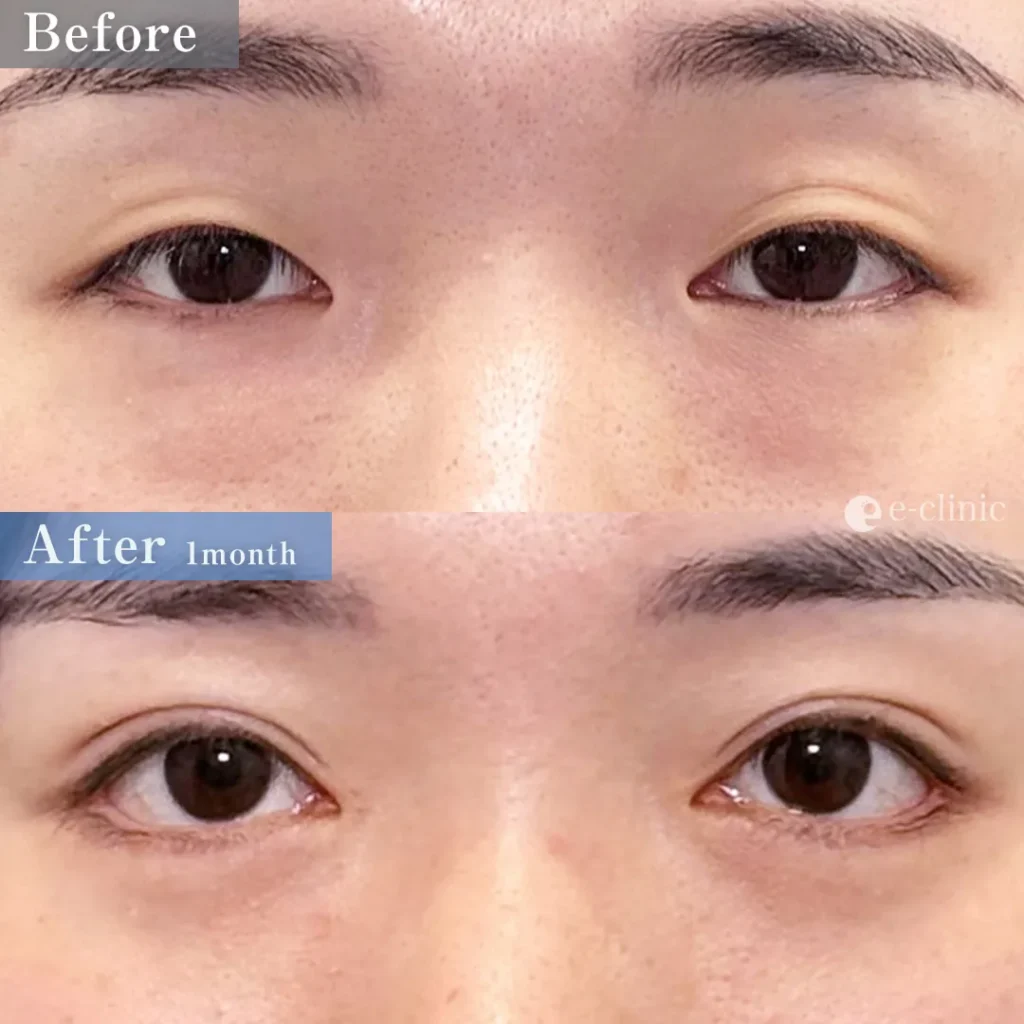 二重埋没法_自然癒着法＋目頭切開＋たれ目形成（皮膚結膜法）＋目尻切開＋クマ取り_裏ハムラ法（八木良太）（82）