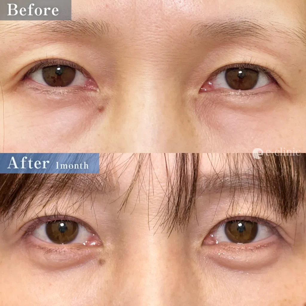 経結膜脱脂＋目の下脂肪注入（コンデンス＋ナノリッチ）＋涙袋ヒアルロン酸（名医の坂本優衣医師）（29）