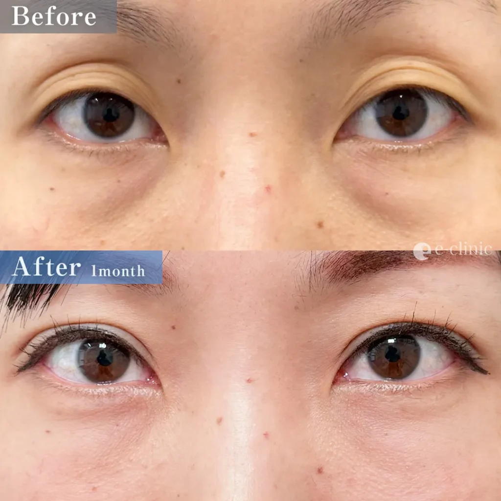 二重埋没法_自然癒着法＋クマ取り_裏ハムラ法（名医の伊藤渉医師が執刀）（66）