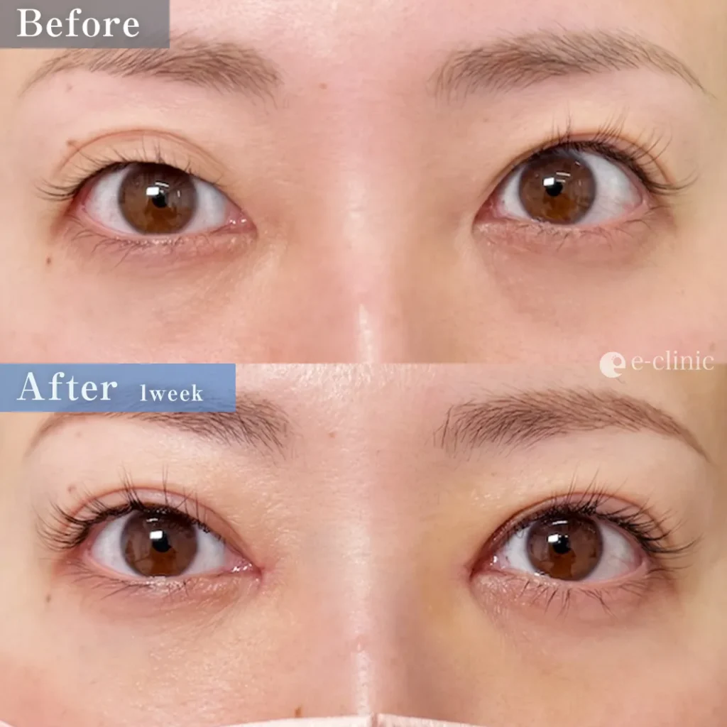 二重埋没法_特殊6点裏留め（他院修正）（名医の伊藤渉医師が執刀）（65）