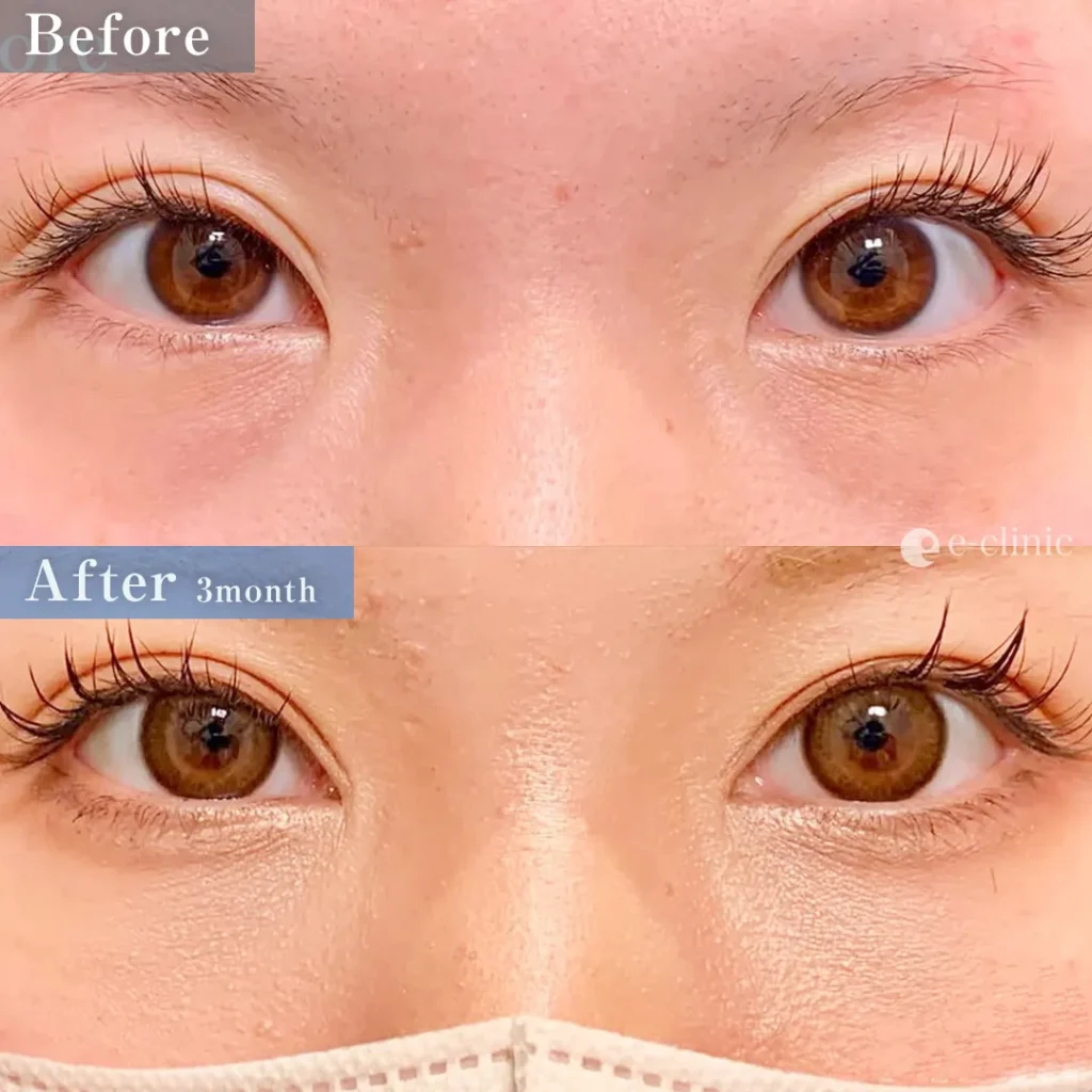 クマ取り_裏ハムラ（名医の張田修平医師が執刀）（18）