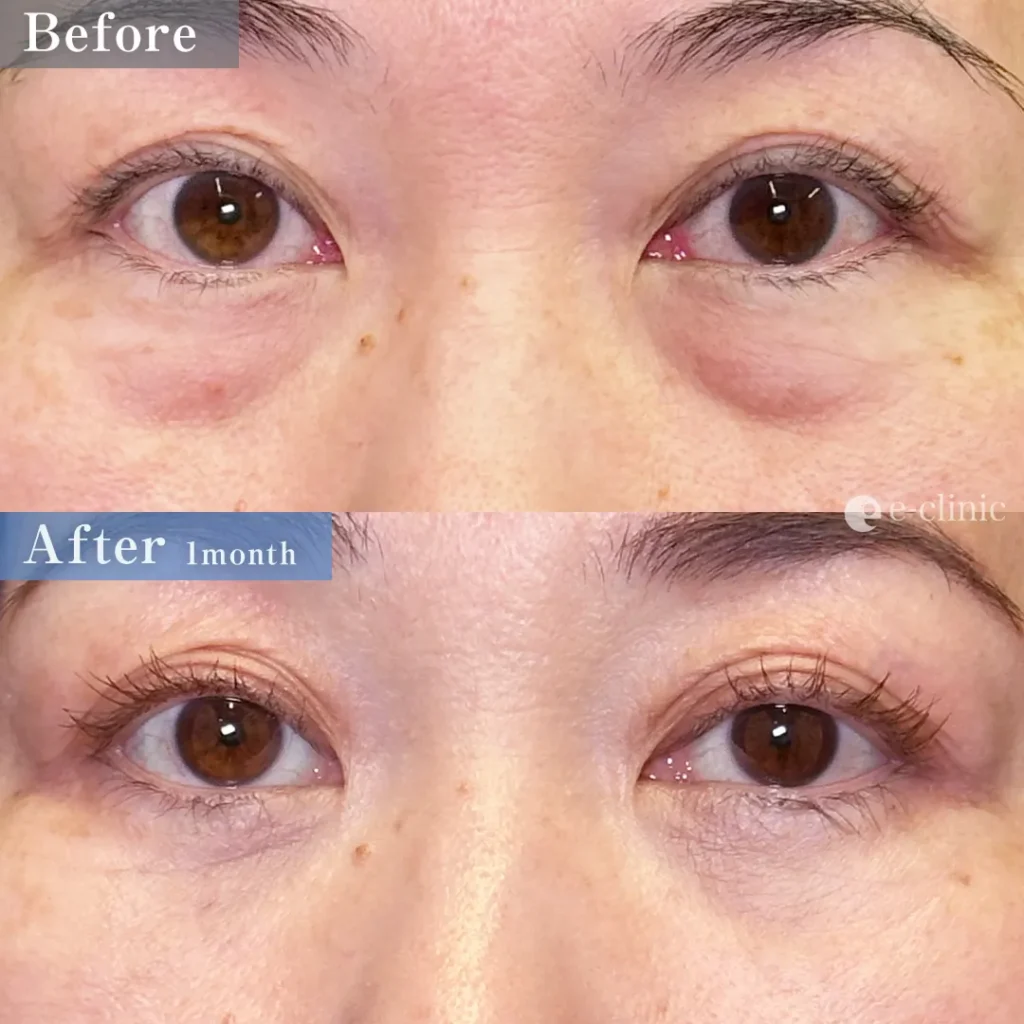 クマ取り_裏ハムラ法（名医の坂本優衣医師が執刀）（32）