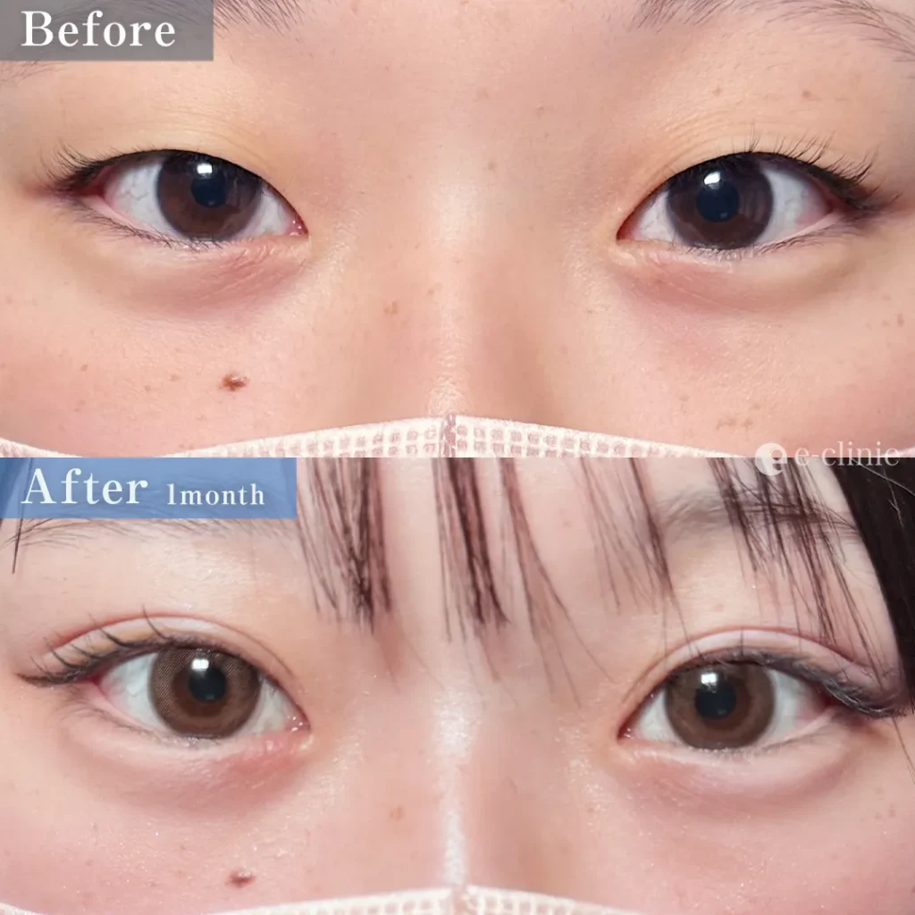 二重埋没法_自然癒着法（名医の伊藤渉医師が執刀）（68）