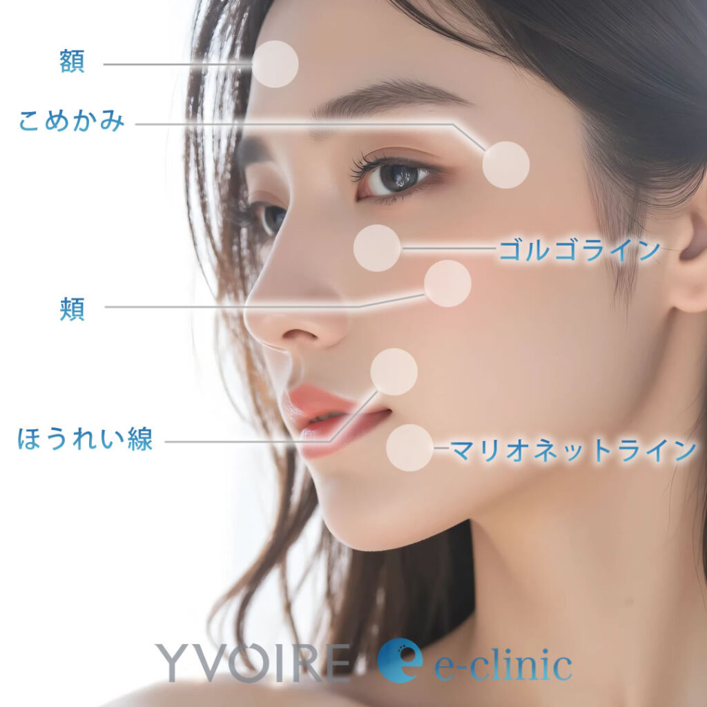 イボアール ボリューム プラスの注入部位の図解