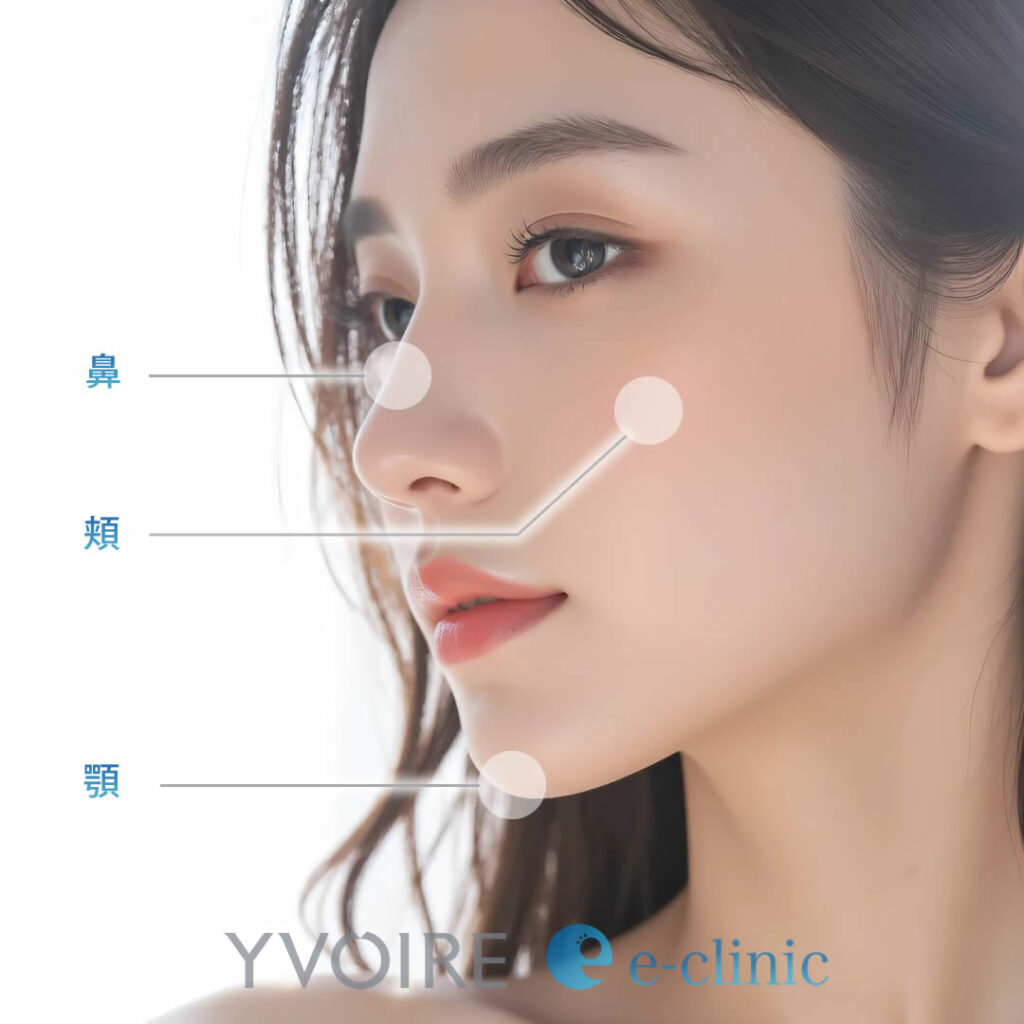 イボアール コントア プラスの注入部位の図解