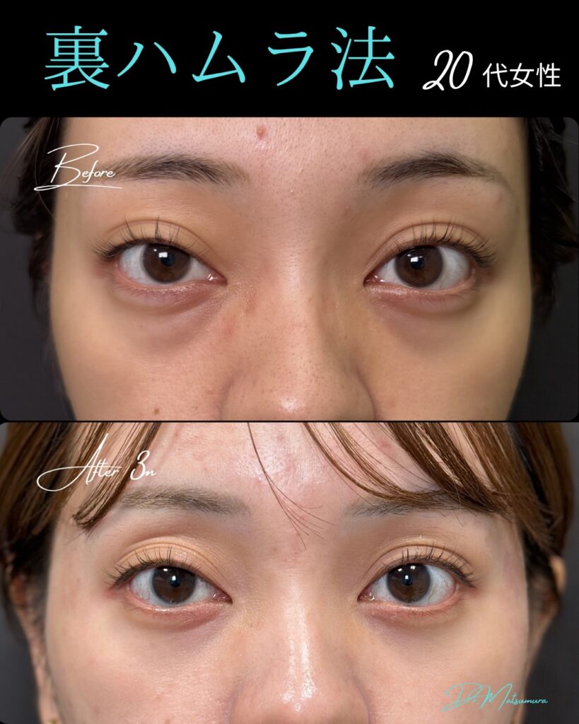 裏ハムラ法の症例写真 (38)