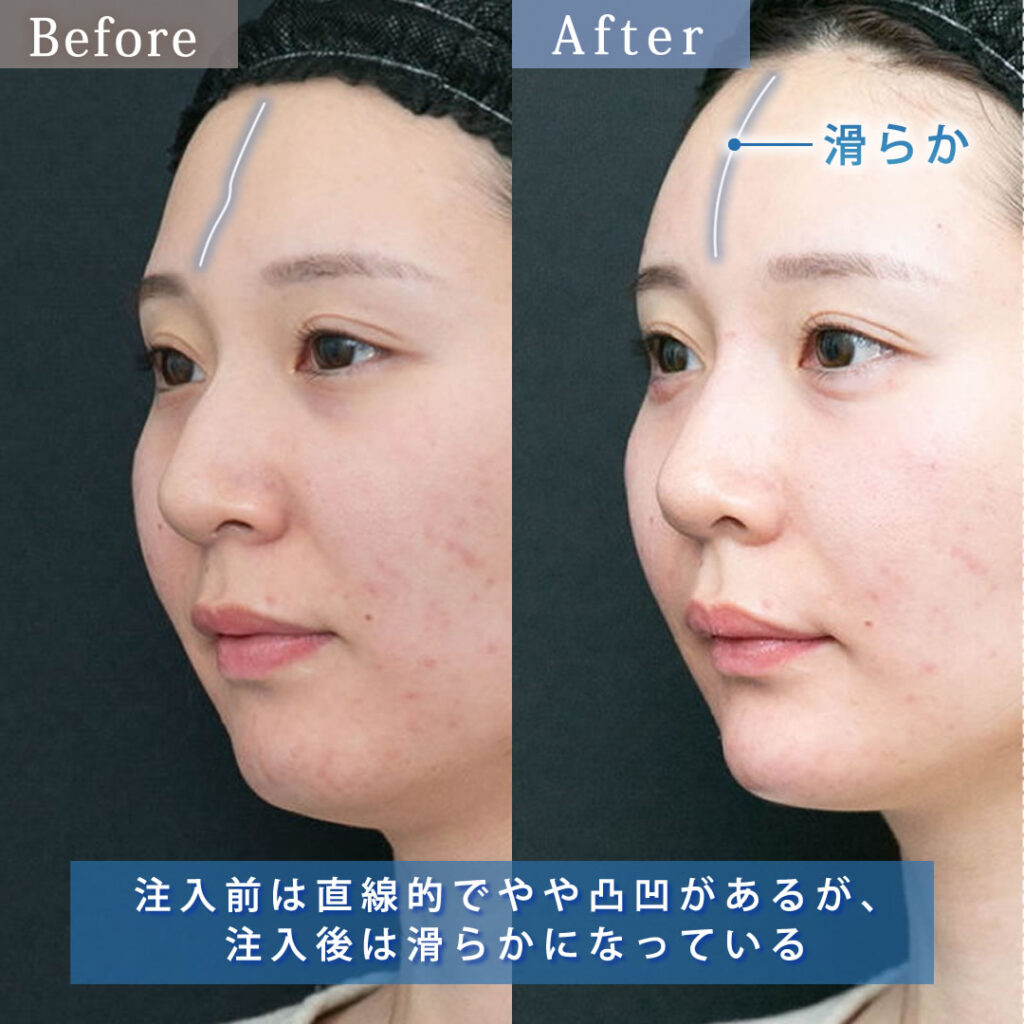 20代のおでこのヒアルロン酸の斜めから見た症例