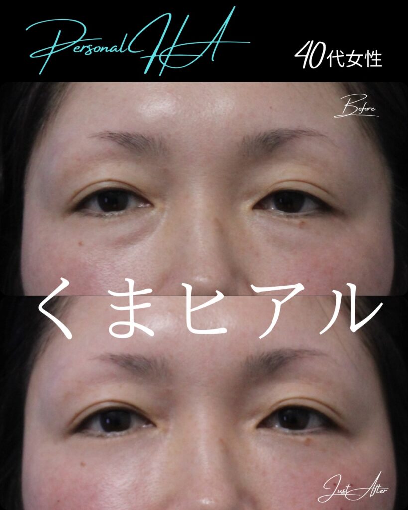 目の下のヒアルロン酸の症例写真 (2)