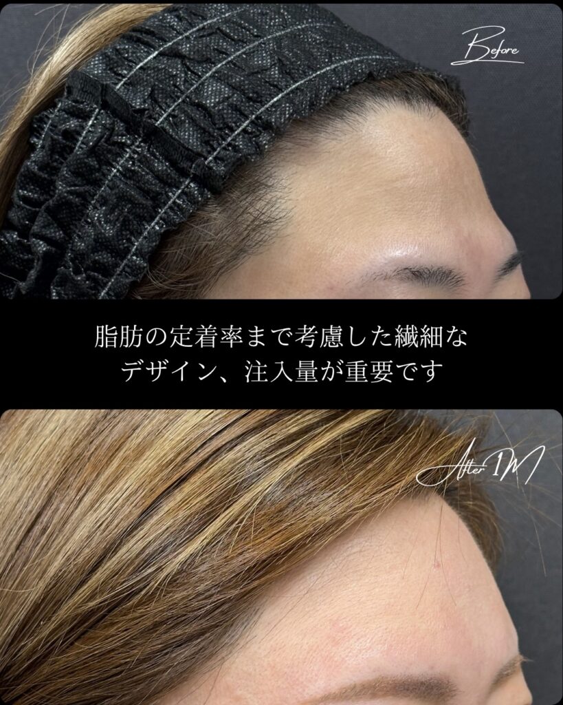 額の脂肪注入の１か月後の症例写真