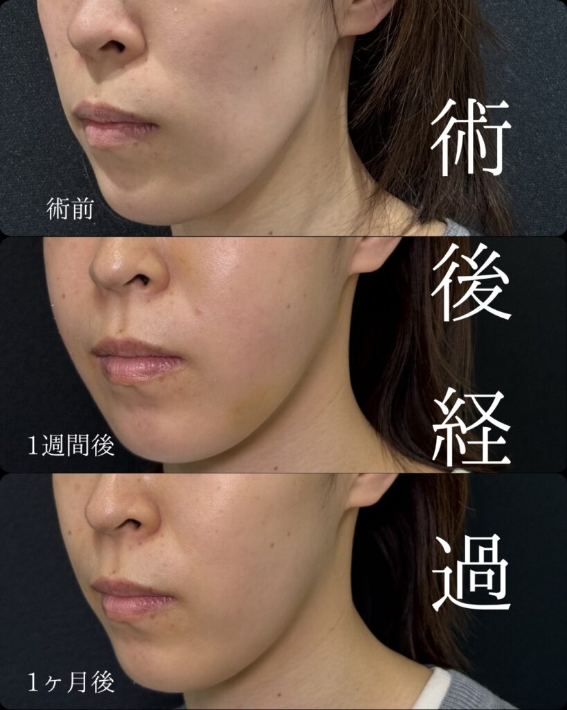 京都院の裏ハムラと脂肪注入（頬、目の下）症例