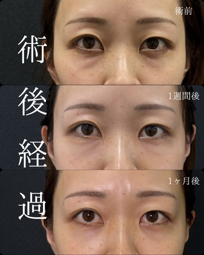 京都院の裏ハムラと目の下の脂肪注入の1週間後と1か月後の症例.