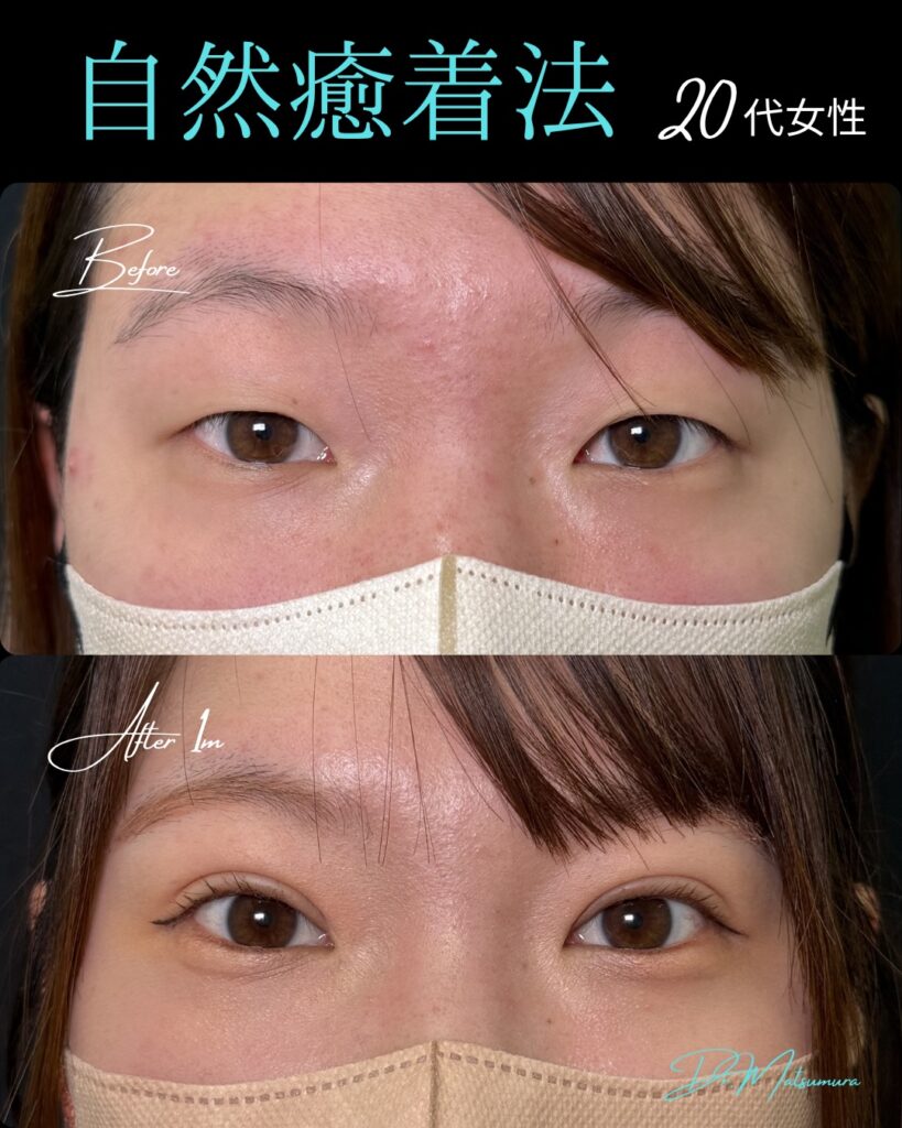 自然癒着法の症例写真 (2)
