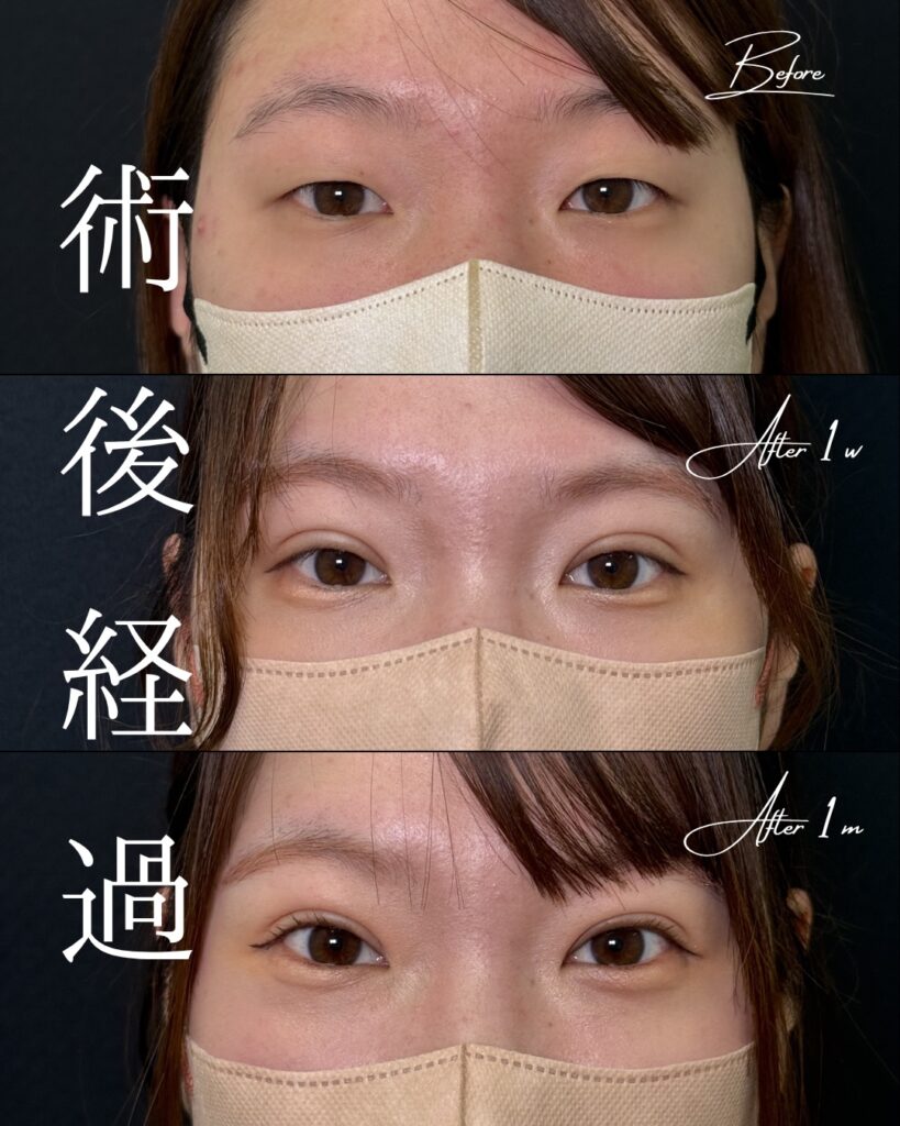 自然癒着法の症例写真 (1)