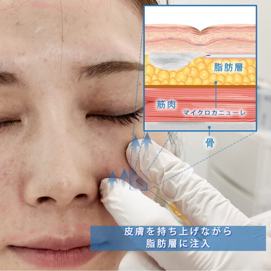頬のヒアルロン酸の注入方法の図解